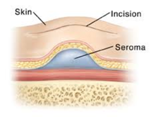 seroma